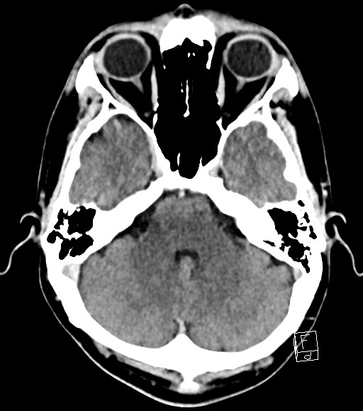 Cerebral metastases - testicular choriocarcinoma (Radiopaedia 84486-99855 Axial C+ delayed 41).jpg