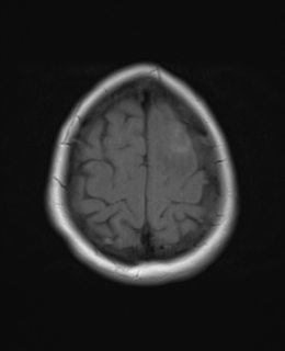 File:Cerebral metastases mimicking abscesses (Radiopaedia 45841-50131 Axial T1 25).png