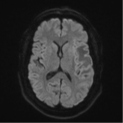 File:Cerebral metastases mimicking multifocal glioblastoma (Radiopaedia 50843-56353 Axial DWI 43).png