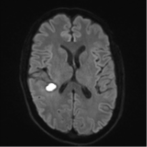 File:Cerebral metastasis - melanoma (Radiopaedia 54718-60954 Axial DWI 47).png
