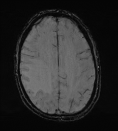 Cerebral metastasis - melanoma (Radiopaedia 54718-60954 Axial SWI 40).png