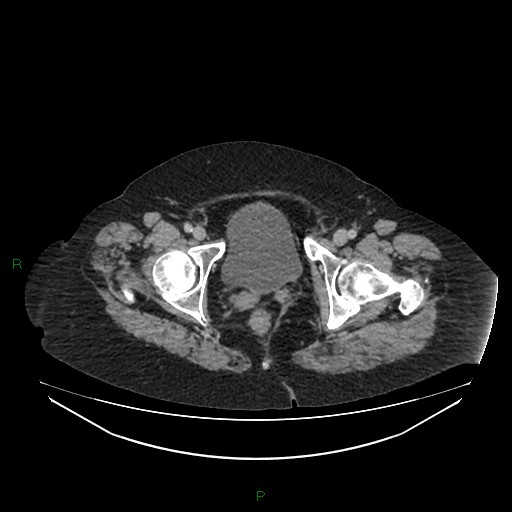 File:Cerebral metastasis from renal cell carcinoma (Radiopaedia 82306-96378 A 185).jpg