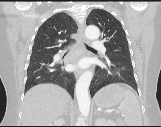 File:Cerebral metastasis to basal ganglia (Radiopaedia 81568-95414 Coronal lung window 52).png