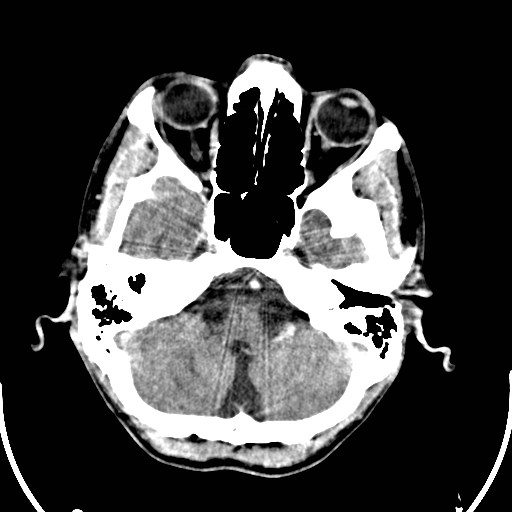 File:Cerebral toxoplasmosis (Radiopaedia 43956-47460 Axial C+ delayed 3).jpg