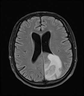 File:Cerebral toxoplasmosis (Radiopaedia 43956-47461 Axial FLAIR 14).jpg
