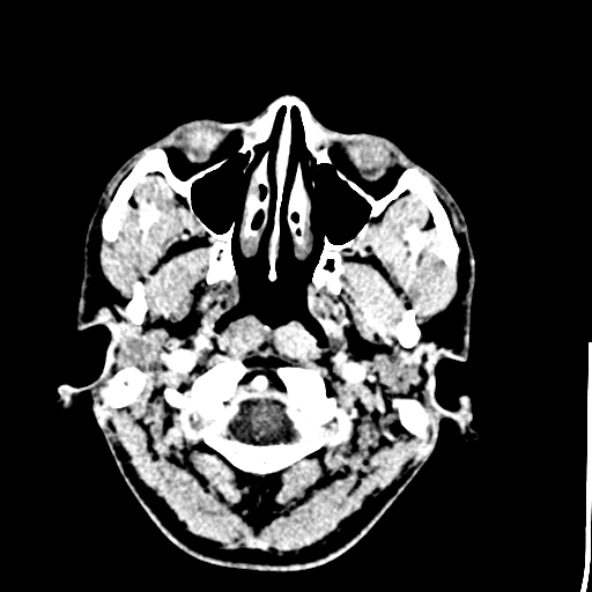 File:Cerebral toxoplasmosis (Radiopaedia 53993-60131 Axial C+ delayed 5).jpg