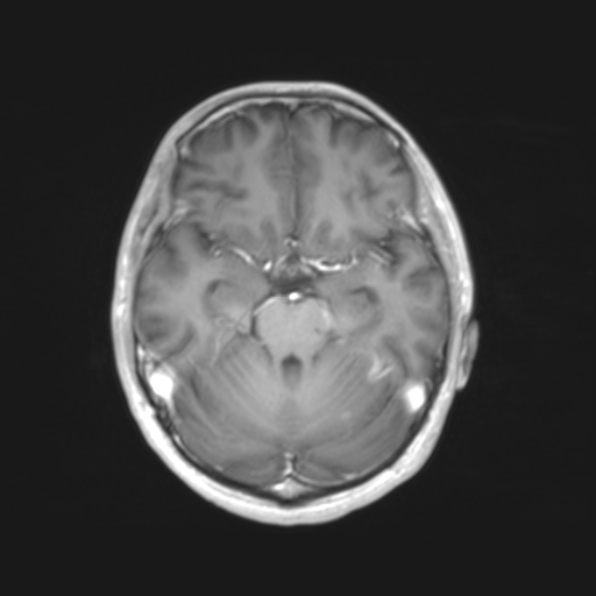 File:Cerebral toxoplasmosis (Radiopaedia 53993-61435 Axial T1 7).jpg