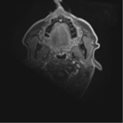 Cerebral toxoplasmosis (Radiopaedia 54575-60804 Axial T1 C+ 1).png
