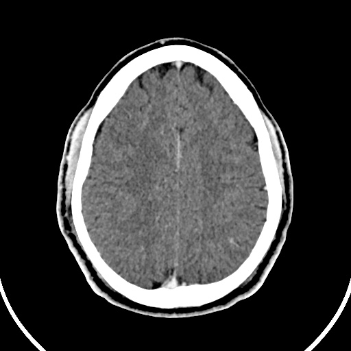 Cerebral venous angioma (Radiopaedia 69959-79977 B 74).jpg