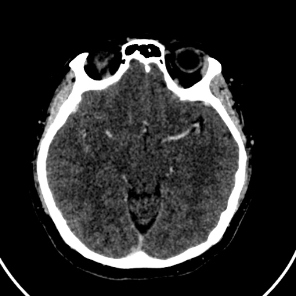 File:Cerebral venous hemorrhagic infarct from venous sinus thrombosis (Radiopaedia 55433-61883 Axial C+ delayed 89).jpg