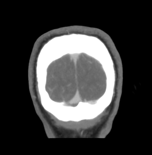 Cerebral venous hemorrhagic infarction (Radiopaedia 38461-40550 Coronal MIP VENOGRAM 55).png