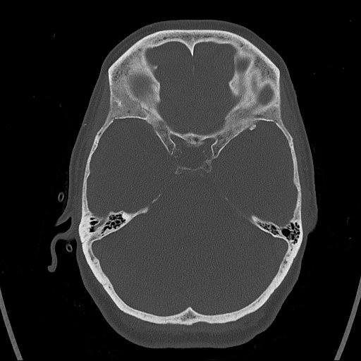 Cerebral venous infarction with hemorrhage (Radiopaedia 65343-74381 Axial bone window 43).jpg