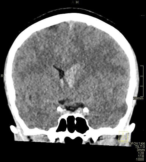 File:Cerebral venous sinus thrombosis (Radiopaedia 91329-108965 Coronal non-contrast 24).jpg