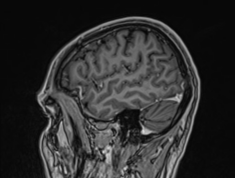 Cerebral venous thrombosis (Radiopaedia 71207-81504 Sagittal T1 C+ 9).jpg