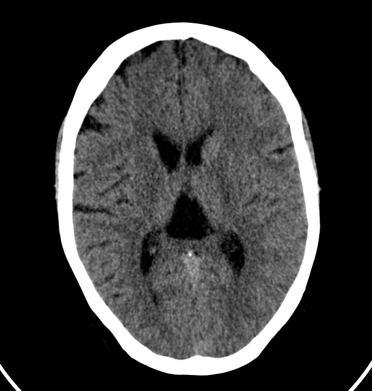 Cerebral venous thrombosis - CT only (Radiopaedia 41031-43778 Axial non-contrast 38).jpg