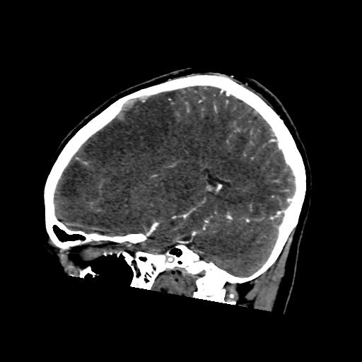 File:Cerebral venous thrombosis - hemorrhagic venous infarction (Radiopaedia 87318-103613 Sagittal 11).jpg