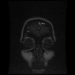 Cerebral venous thrombosis - ulcerative colitis (Radiopaedia 66049-75219 Coronal MRV 107).jpg