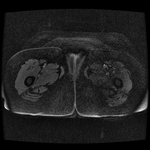 Cervical carcinoma (Radiopaedia 70924-81132 Axial T1 C+ fat sat 179).jpg