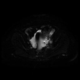 Cervical carcinoma (Radiopaedia 85405-101028 Axial DWI 13).jpg