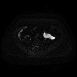 Cervical carcinoma (Radiopaedia 85405-101028 Axial DWI 40).jpg