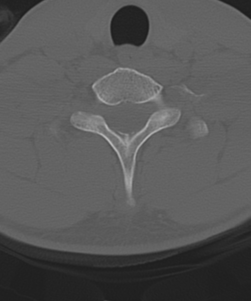 Cervical intercalary bone (Radiopaedia 35211-36748 Axial bone window 52).png