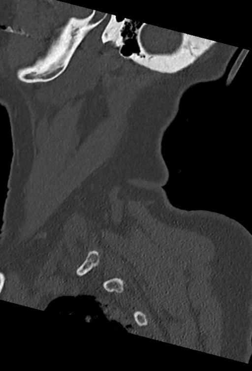 Cervical spine ACDF loosening (Radiopaedia 48998-54070 Sagittal bone window 74).png