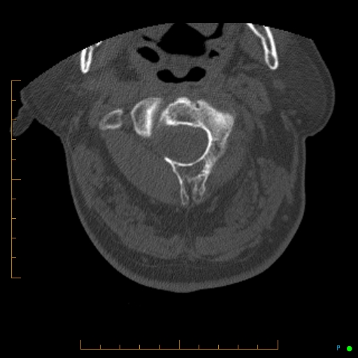 Cervical spine fracture - ankylosing spondylitis (Radiopaedia 76835-88706 Axial bone window 46).jpg