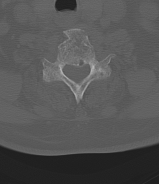 Cervical spine fracture in the setting of ankylosis (Radiopaedia 37038-38715 Axial bone window 45).png