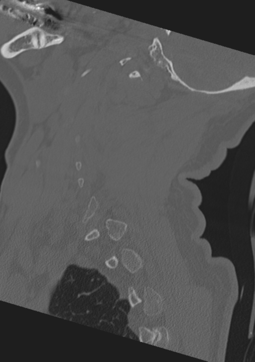 Cervical spine fractures with vertebral artery dissection (Radiopaedia 53296-59268 Sagittal bone window 14).png
