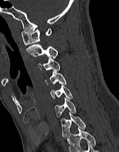 Cervical spondylodiscitis (Radiopaedia 28057-29489 Sagittal bone window 27).jpg