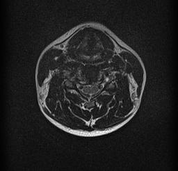 File:Cervical spondylodiscitis and calvarial hemangioma (Radiopaedia 64317-73104 Axial T2 9).jpg