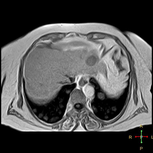 File:Cervical stump squamous cell carcinoma (Radiopaedia 48049-52858 H 17).jpg