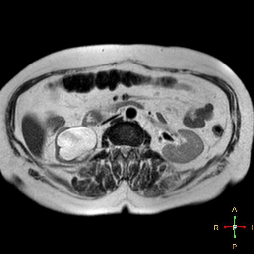 File:Cervical stump squamous cell carcinoma (Radiopaedia 48049-52858 I 3).jpg