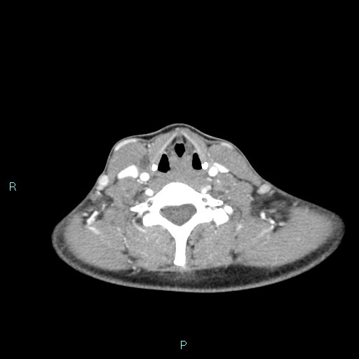 Cervical thymic cyst (Radiopaedia 88632-105335 B 47).jpg