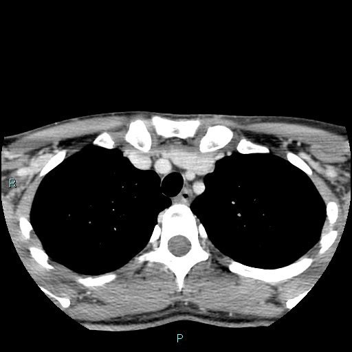 Cervical thymic cyst (Radiopaedia 88632-105335 C 13).jpg