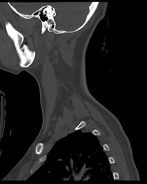 Cervical tuberculous spondylitis (Radiopaedia 39149-41365 Sagittal bone window 61).png