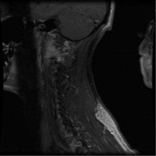 File:Cervical vertebrae metastasis (Radiopaedia 78814-91667 G 12).png