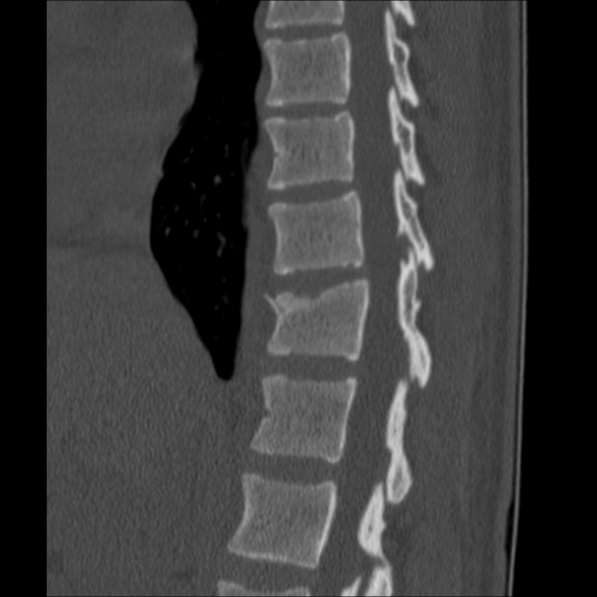 Chance fracture (Radiopaedia 36521-38081 Sagittal bone window 24).jpg