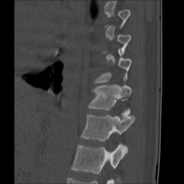 Chance fracture (Radiopaedia 36521-38081 Sagittal bone window 50).jpg