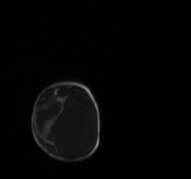 Chiari III malformation with occipital encephalocele (Radiopaedia 79446-92559 Coronal T1 C+ mpr 71).jpg