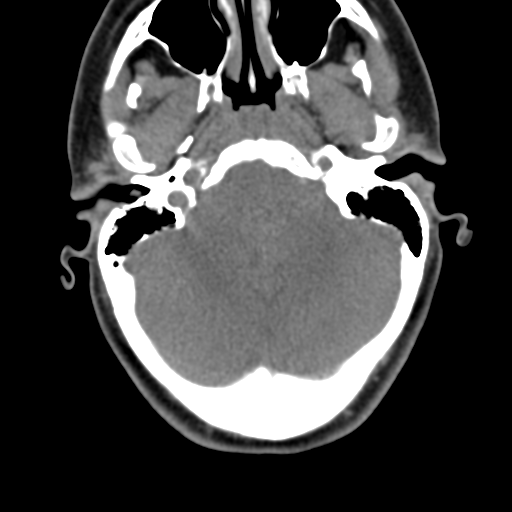 Chiari I malformation and obstructive hydrocephalus (Radiopaedia 41185-43981 D 26).png