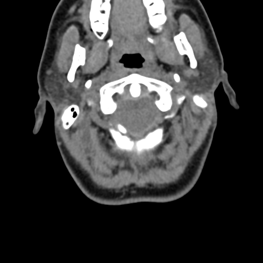 Chiari I malformation and obstructive hydrocephalus (Radiopaedia 41185-43981 D 33).png