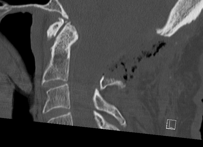 Chiari I malformation with a symptomatic syrinx of the posterolateral medulla oblongata (Radiopaedia 42573-45707 A 32).jpg