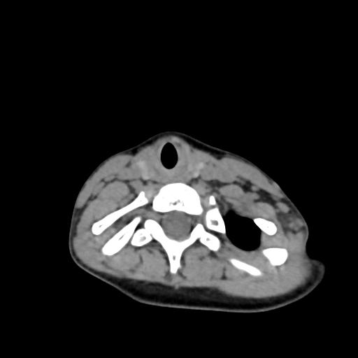 Chiari I with syrinx and skull base anomalies (Radiopaedia 89444-106412 Axial non-contrast 112).jpg