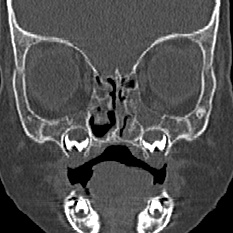Choanal atresia (Radiopaedia 88525-105975 Coronal bone window 35).jpg