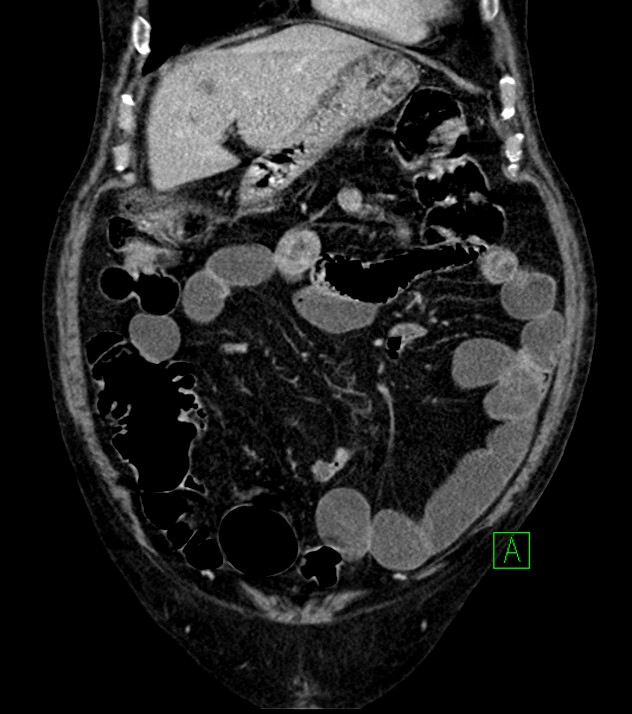 Cholangiocarcinoma with cerebral metastases (Radiopaedia 83519-98629 G 22).jpg
