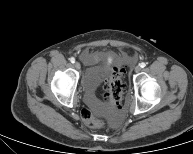 Cholecystitis - perforated gallbladder (Radiopaedia 57038-63916 A 75).jpg