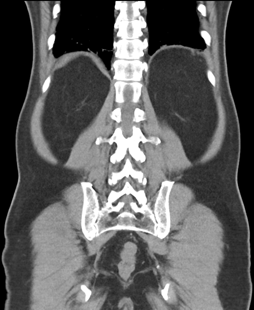 Cholecystitis with focal perforation and hepatic abscess (Radiopaedia 37189-38945 Coronal non-contrast 46).png