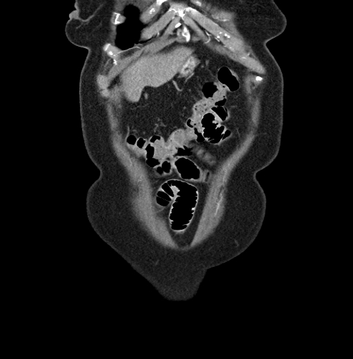 File:Cholecystoduodenal fistula due to calculous cholecystitis with gallstone migration (Radiopaedia 86875-103077 B 7).jpg