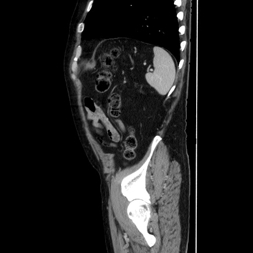 Choledocholiathiasis with normal caliber common bile duct (Radiopaedia 75368-86632 D 126).jpg